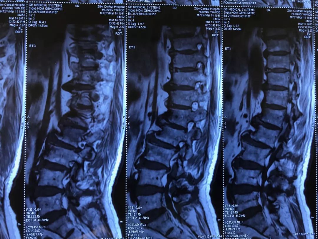 康復醫學新法治療老年人腰椎管狹窄效果好