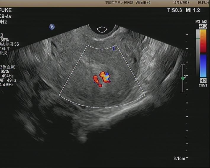 图为药物流产后,经阴彩超能清楚看到宫腔内的血流情况,对诊断胚胎组织