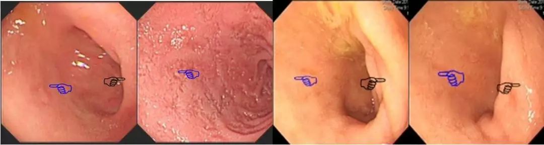 【收藏】胃鏡新手必看——觀察篇_十二指腸