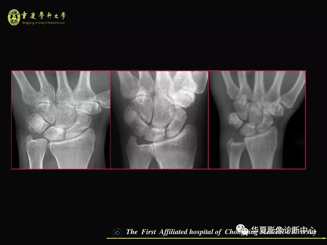 影像基础腕关节损伤mri