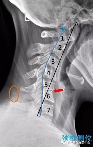 第5-7颈椎椎体后缘下角变尖(蓝色箭头;颈椎4/5椎间隙变窄.