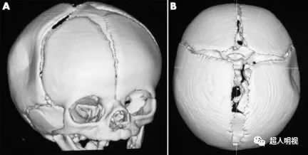 先天性颅骨凹陷图片图片