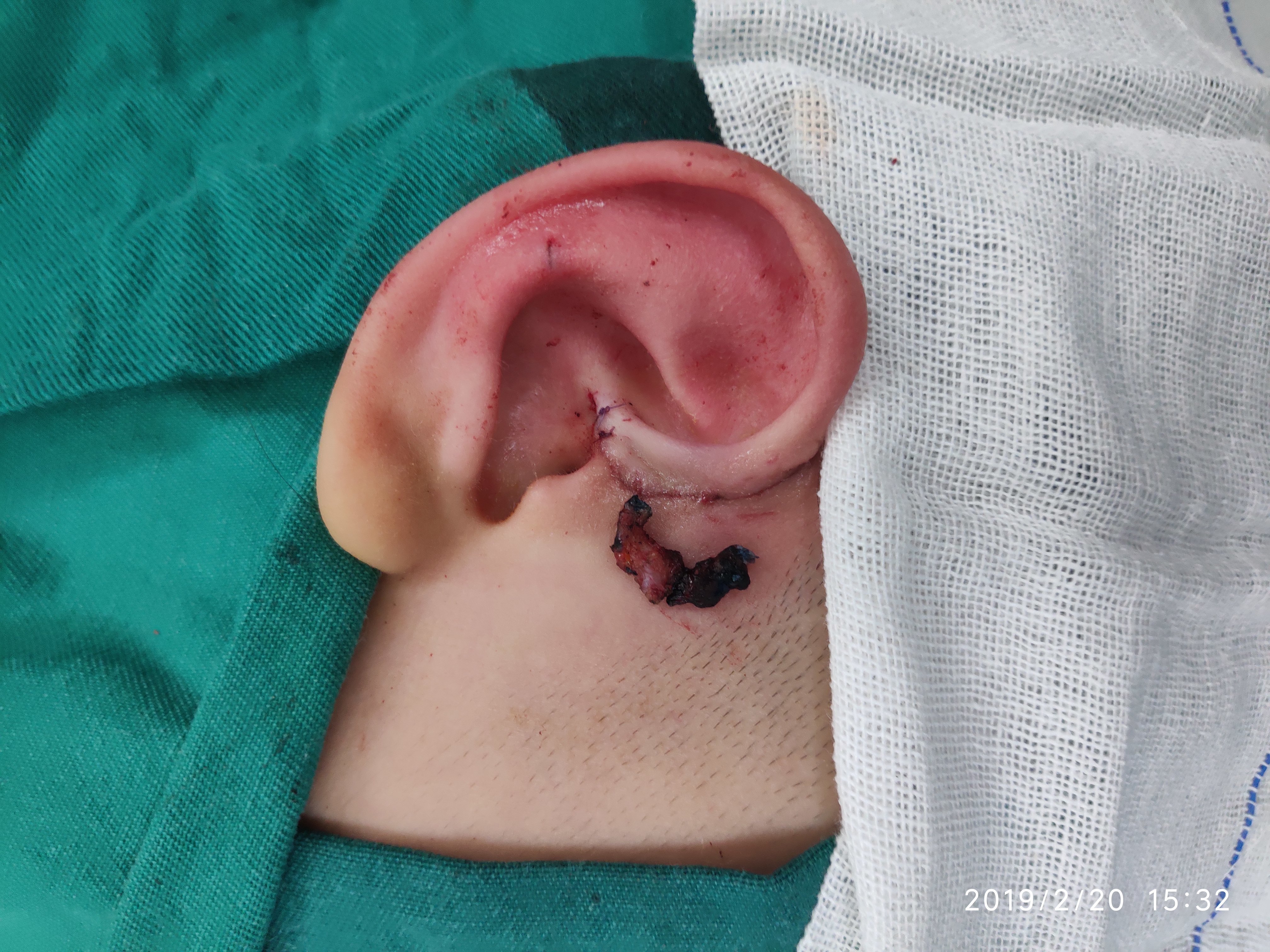 罕见双瘘口先天性耳前瘘管切除术原创