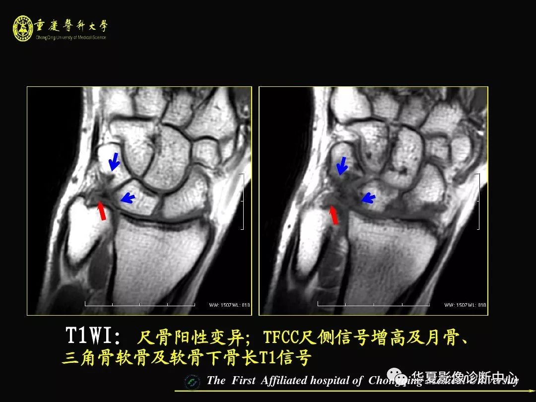 拇长屈肌腱解剖图mri图片