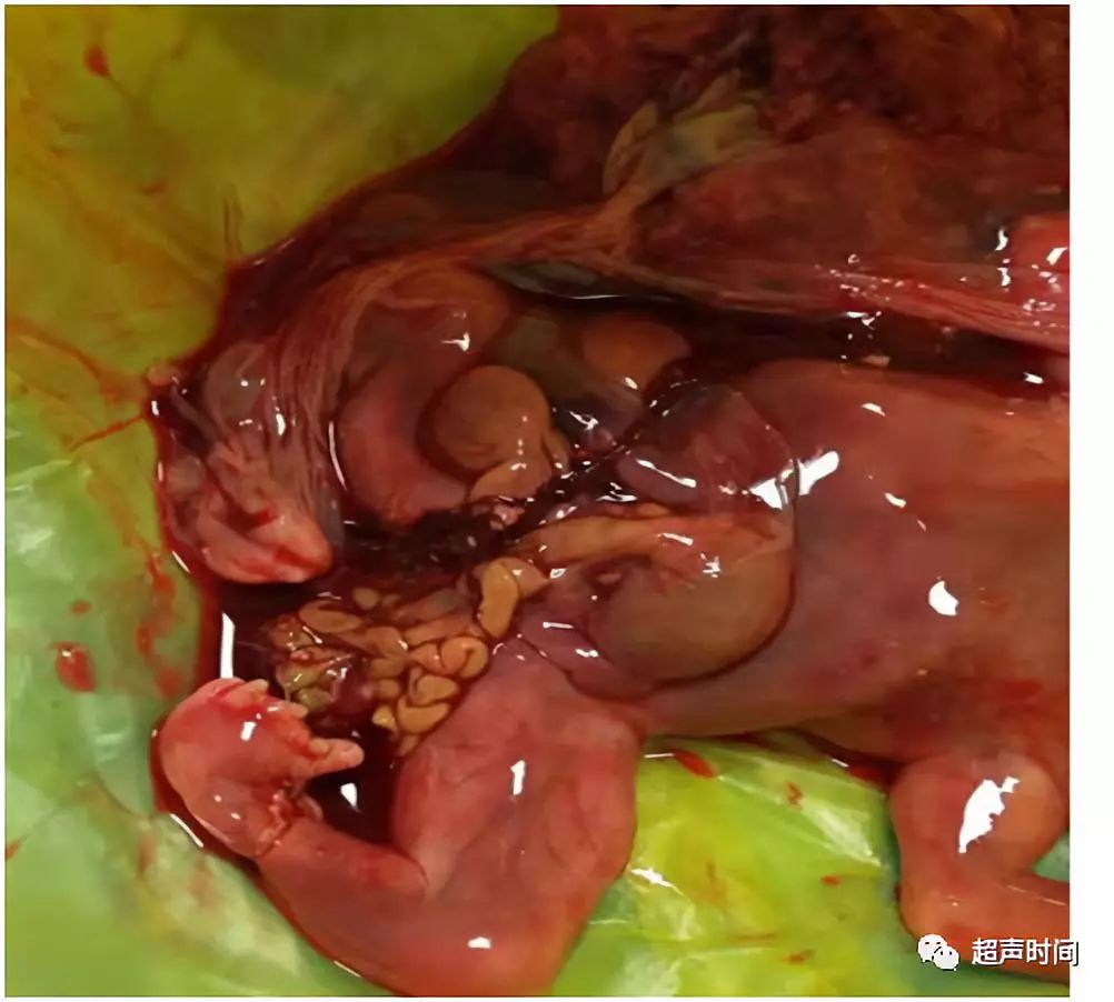 胎儿挤压内脏图片图片