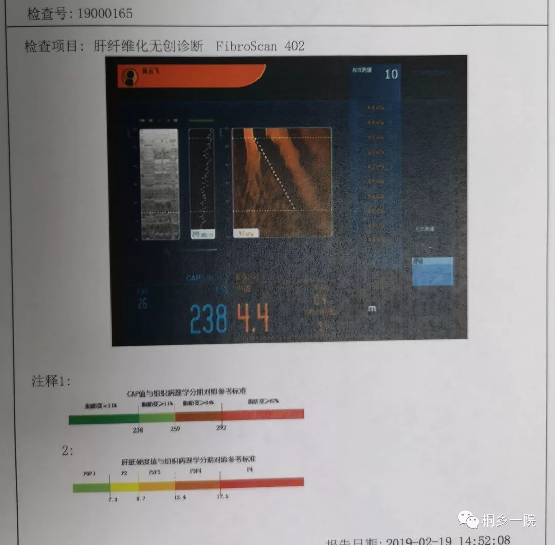 小夥攜帶乙肝病毒三十年,醫生一招測出他的肝臟有多