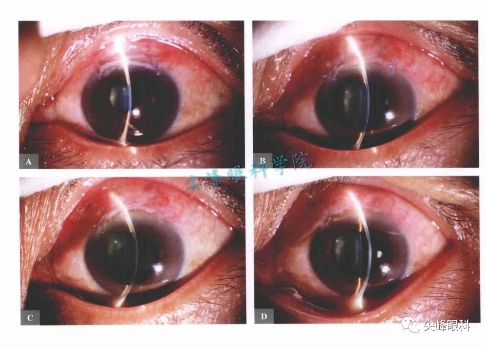 小梁切除术 后遗症图片