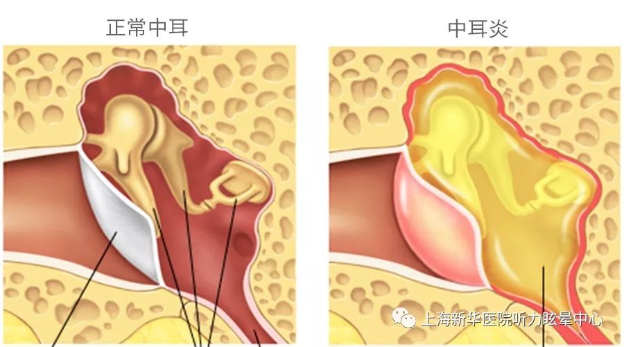 「兒童聽力專欄」寶寶的耳朵出現各種問題,聽力下降了,怎麼辦?_中耳