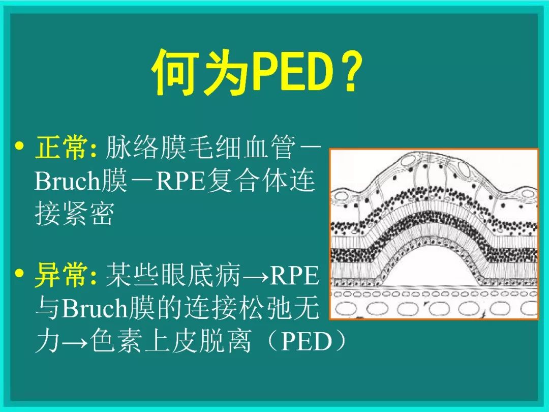 bruch膜眼科图片