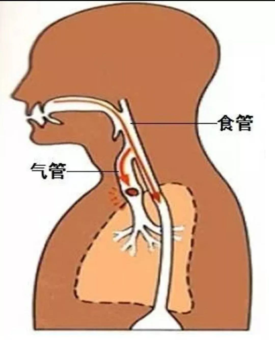 宝宝将本应该进入食道的食物或其他异物