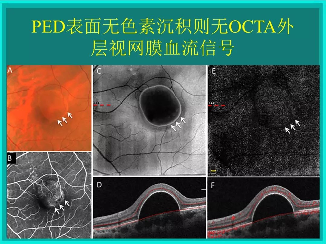 bruch膜眼科图片