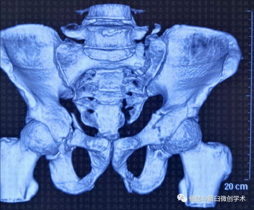 ota61c13型骨盆骨折合併ota62b31型髖臼骨折的微創治療骶髂螺釘前柱