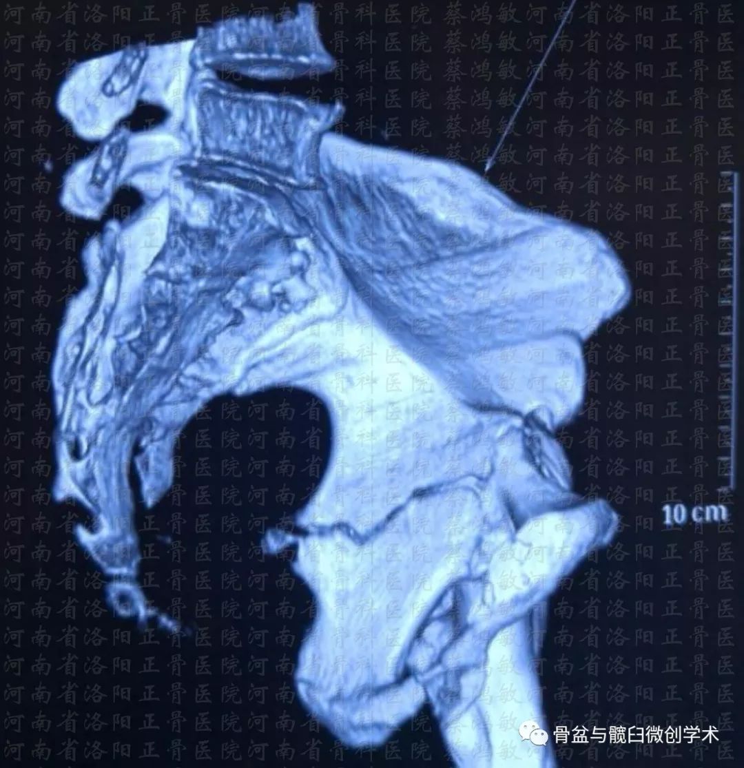 ota61c13型骨盆骨折合併ota62b31型髖臼骨折的微創治療骶髂螺釘前柱