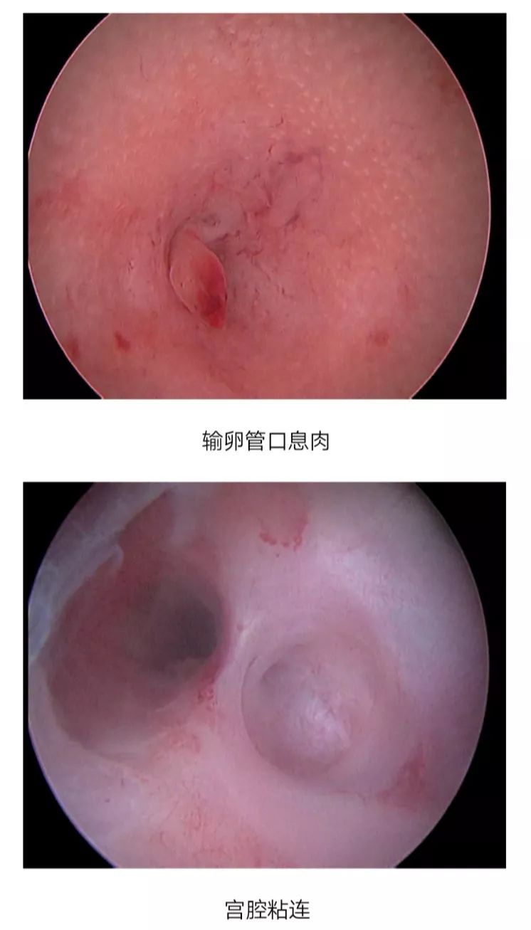 子宫内膜增生宫腔镜图片