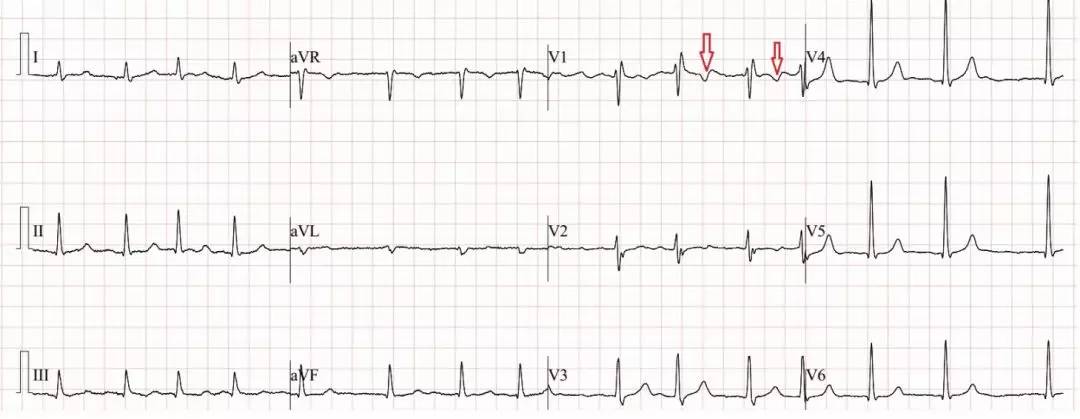心电图stt改变别害怕图片