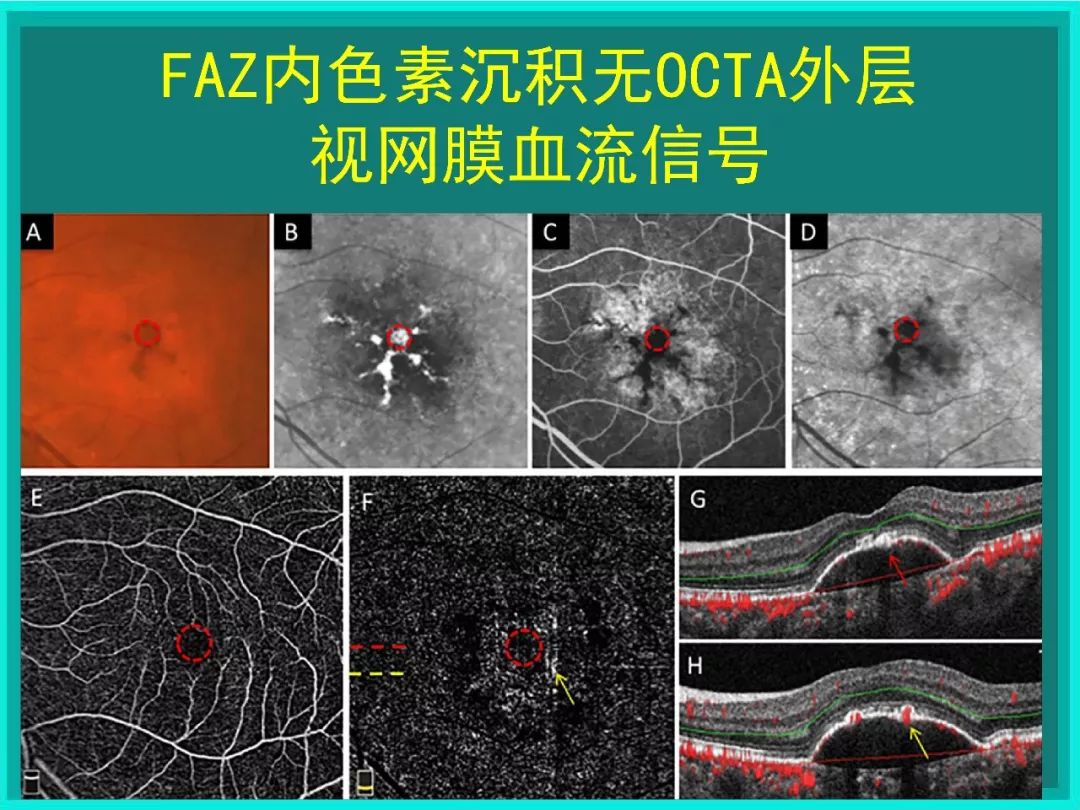 bruch膜眼科图片