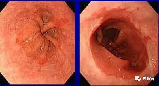 巴雷特食管症状图片图片