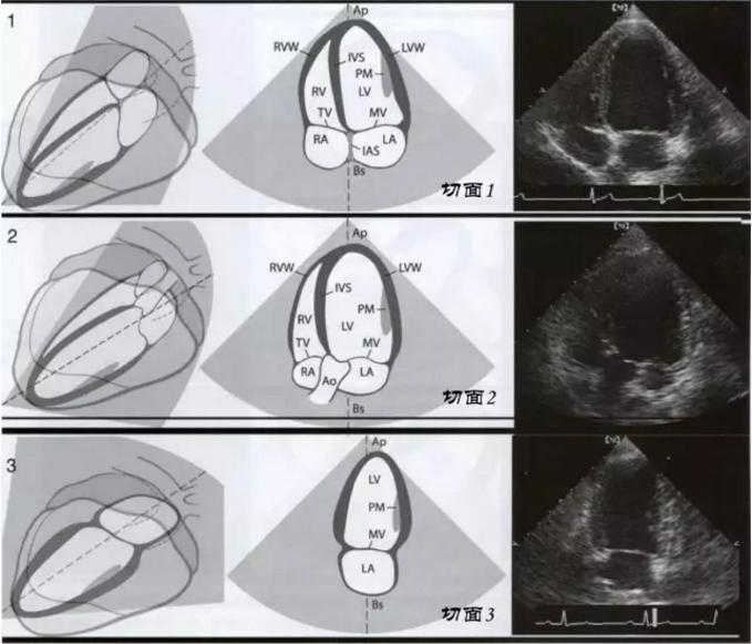 心脏彩超四腔心解剖图图片