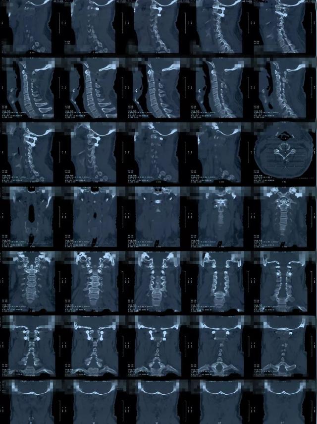 音频病例点评颈12髓内室管膜瘤