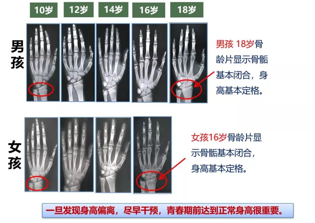 12岁儿童骨密度对照表图片