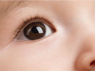患结膜炎的宝贝,眼白部分看起来发粉红色,严重时眼皮睫毛被分泌物粘合