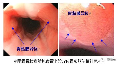 巴雷特食管舌形图片