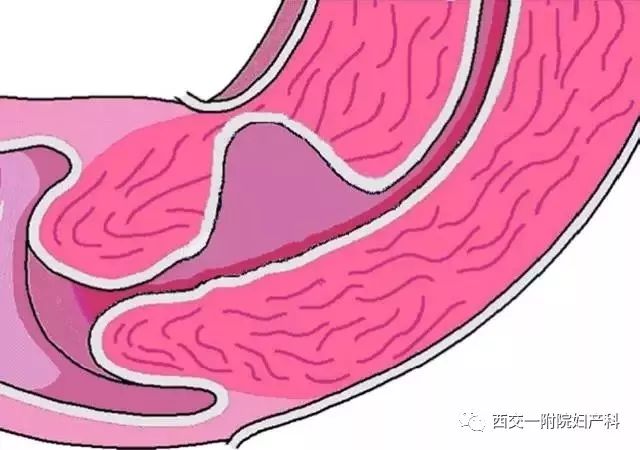 剖宫产术后并发症之一剖宫产切口瘢痕愈合不良及分型