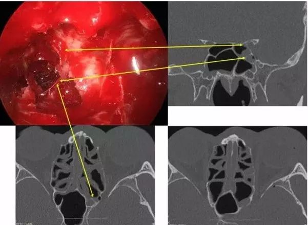 手術視頻同仁醫院康軍內鏡經鼻入路眶視神經管區病變的手術治療要點