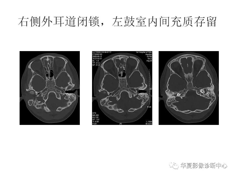 先天性外耳道闭锁图片