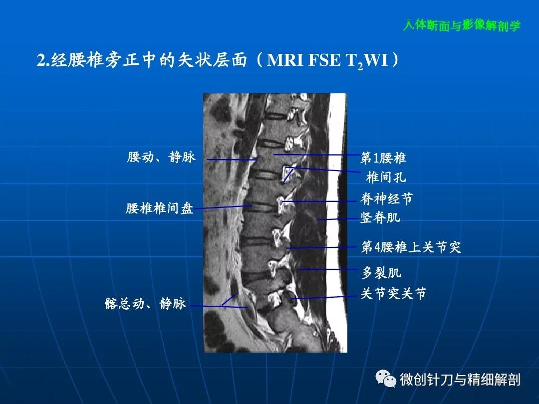 椎弓根的影像解剖图图片