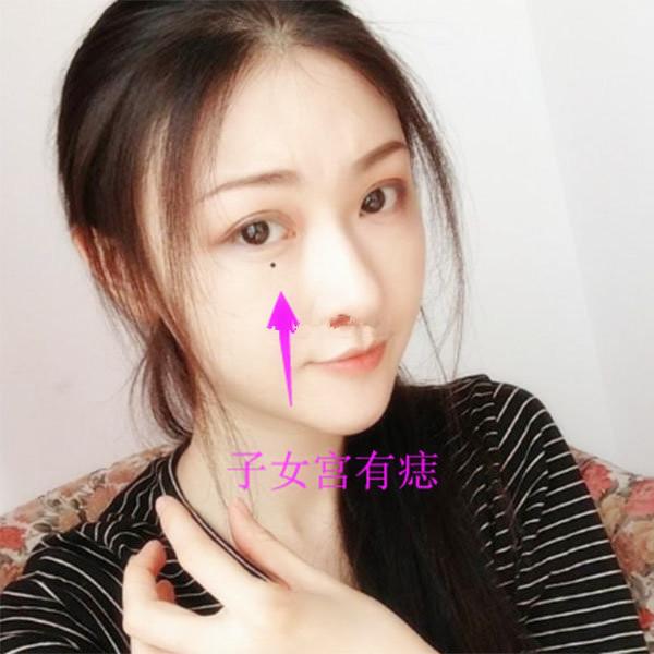 女人克夫痣图片图片