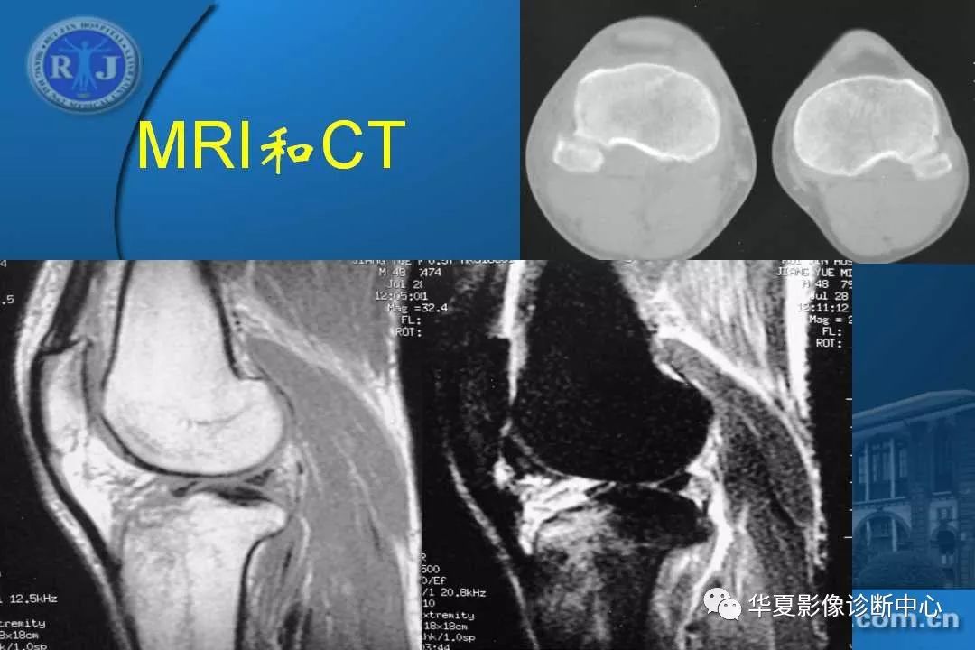 膝關節半月板和韌帶損失以外病變的mri診斷