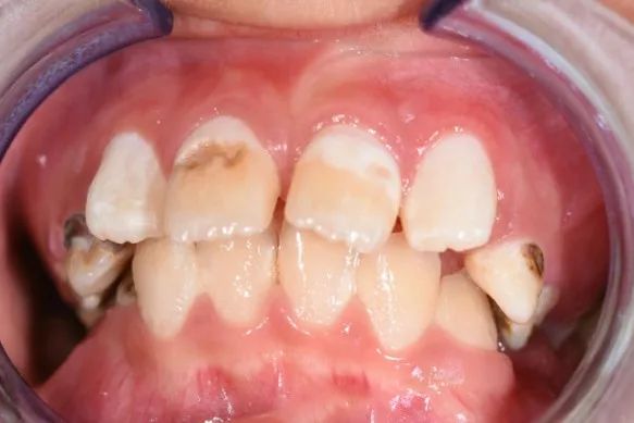 牙釉质发育不全(更容易发生龋坏),恒牙异位萌出(牙齿不齐)3,养成偏