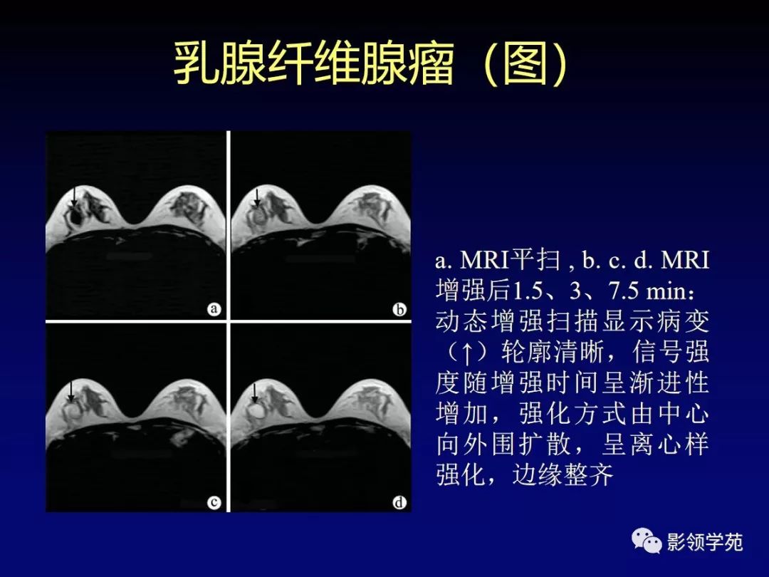 乳腺良惡性腫瘤圖譜