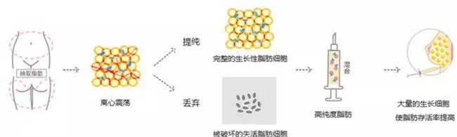 姐姐假体隆胸PK自体脂肪丰胸，宠妃之争最后谁赢了？