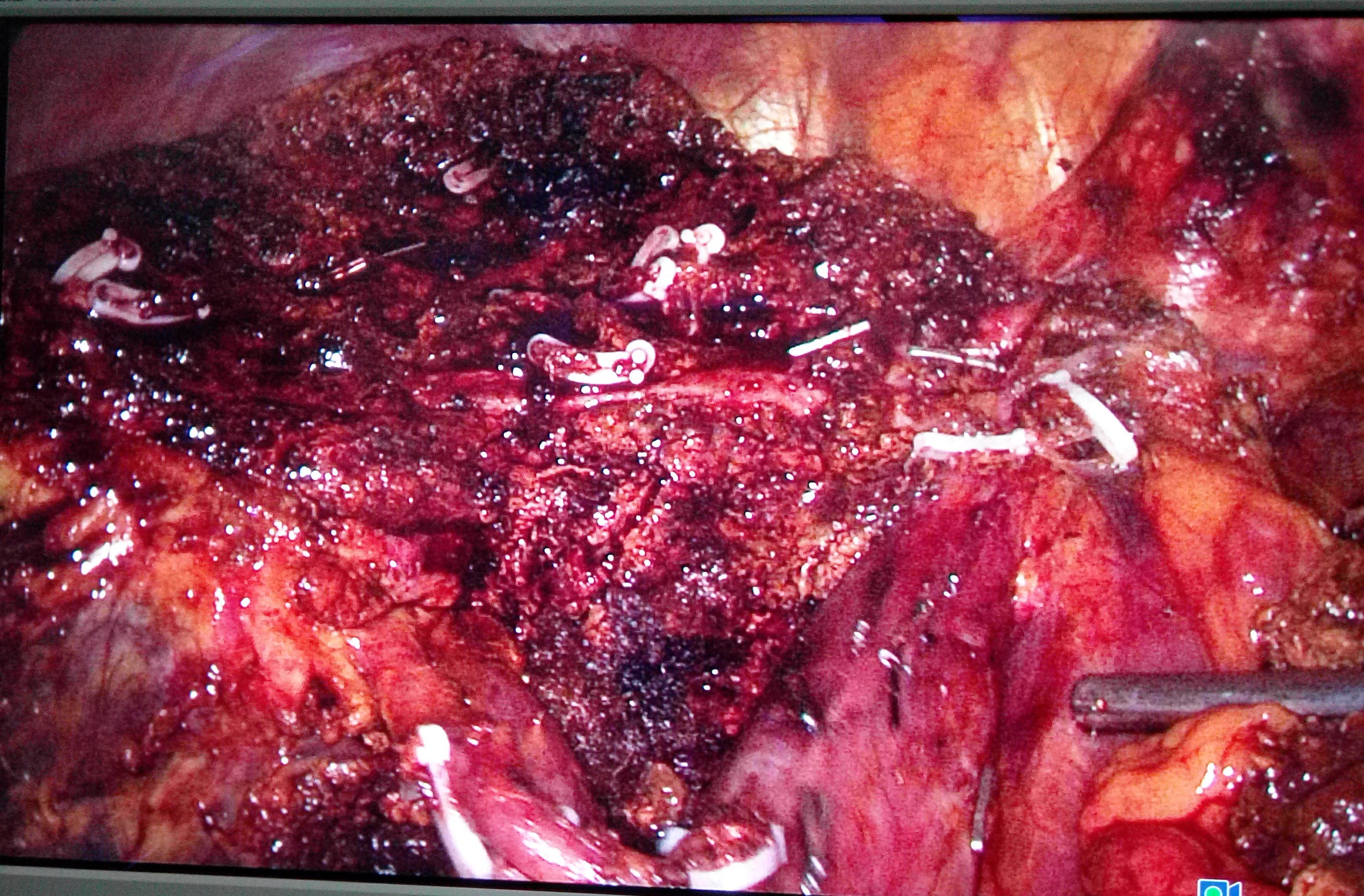 腹腔癌图片