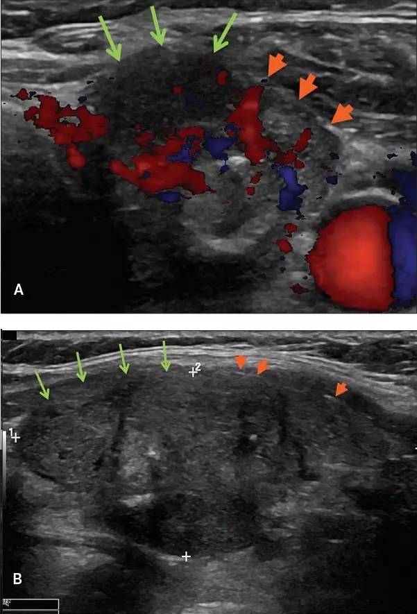 超聲甲狀腺乳頭狀癌被膜外浸潤