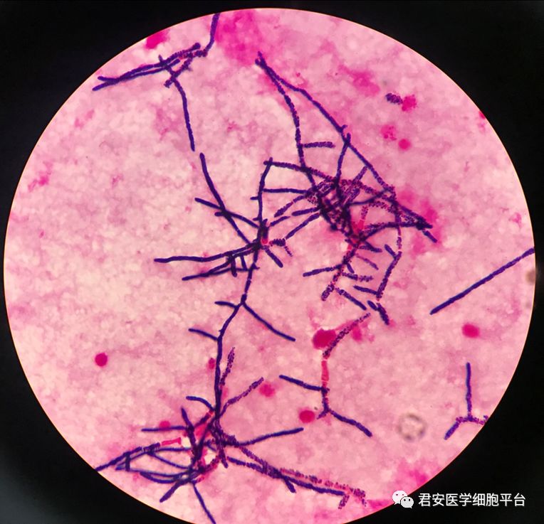 马尔尼菲蓝状菌患者图片