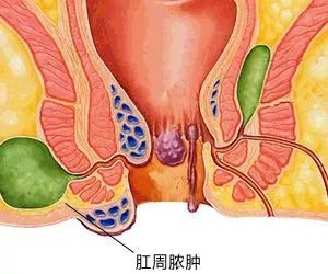 肛门外长疙瘩图图片