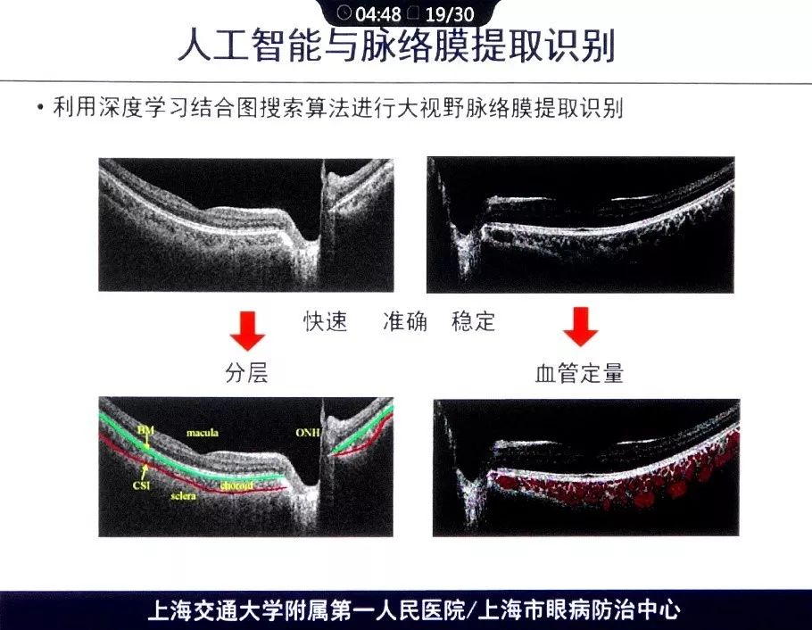 bruch膜图片