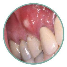 大牙牙龈肿痛化脓图片图片