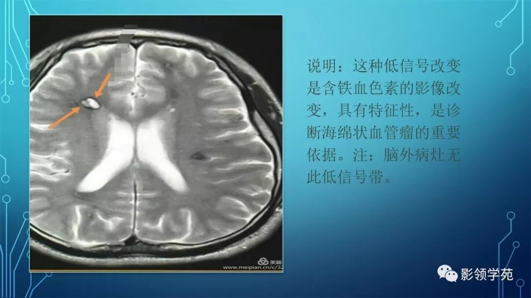 颅内多发海绵状血管瘤