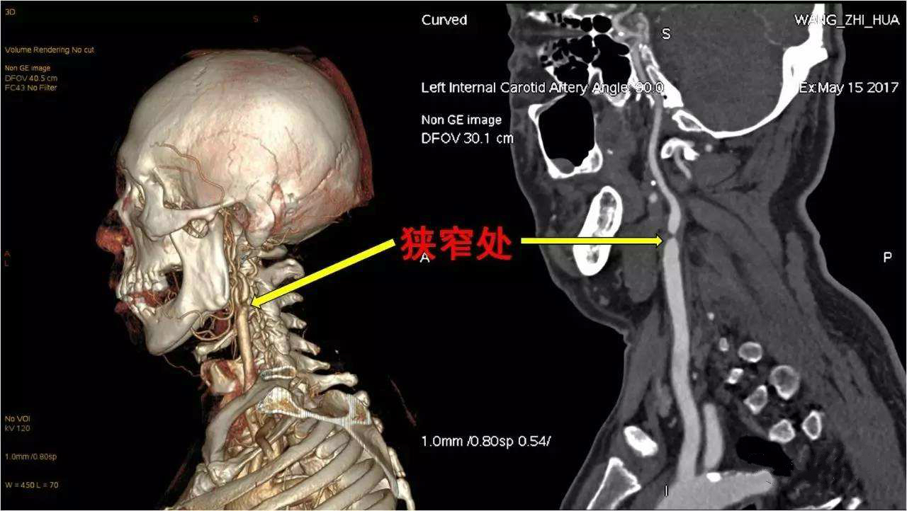 双侧颈动脉斑块图片图片