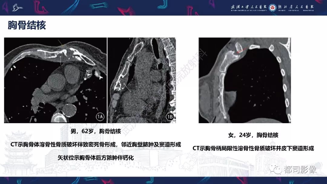 胸锁关节ct扫描范围图片