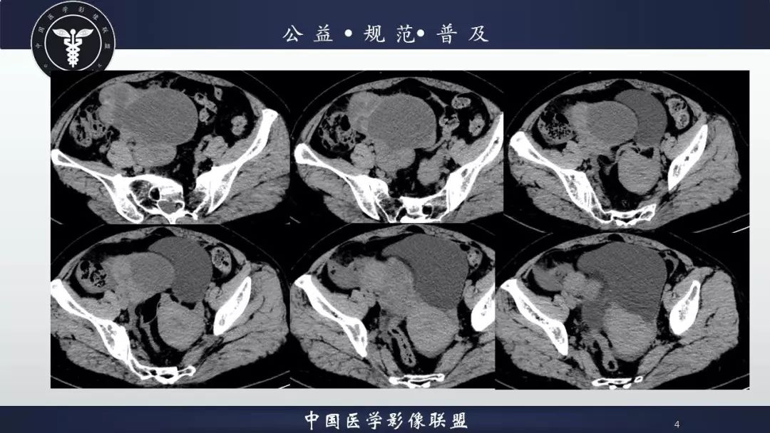 卵巢子宮內膜樣癌兩例