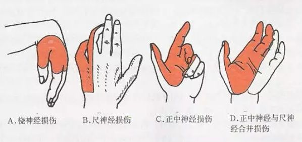爪形手 猿形手图片