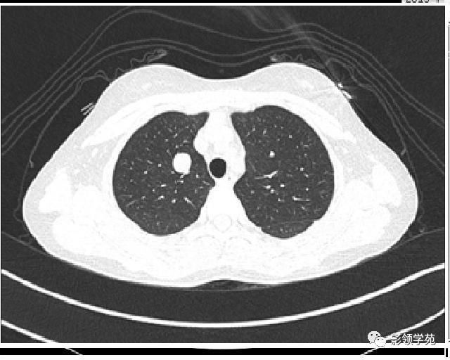 CT肺部有阴影代表什么？