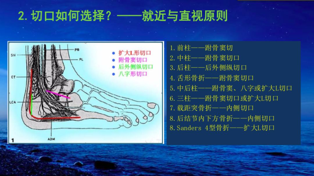 今天分享一組來自@歸海依刀的精美課件,對跟骨骨折用跗骨竇切口手術