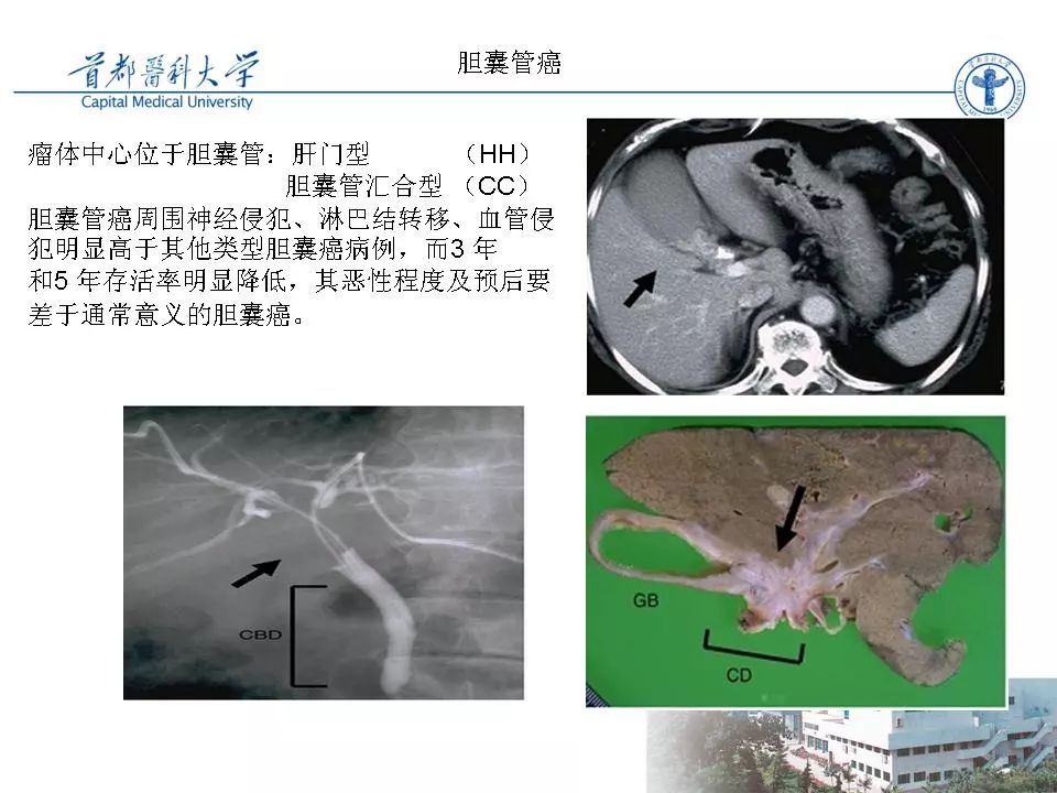 胆囊癌ct诊断影像天地