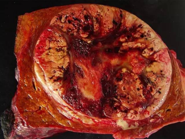 14种常见肝脏良恶性肿瘤图解
